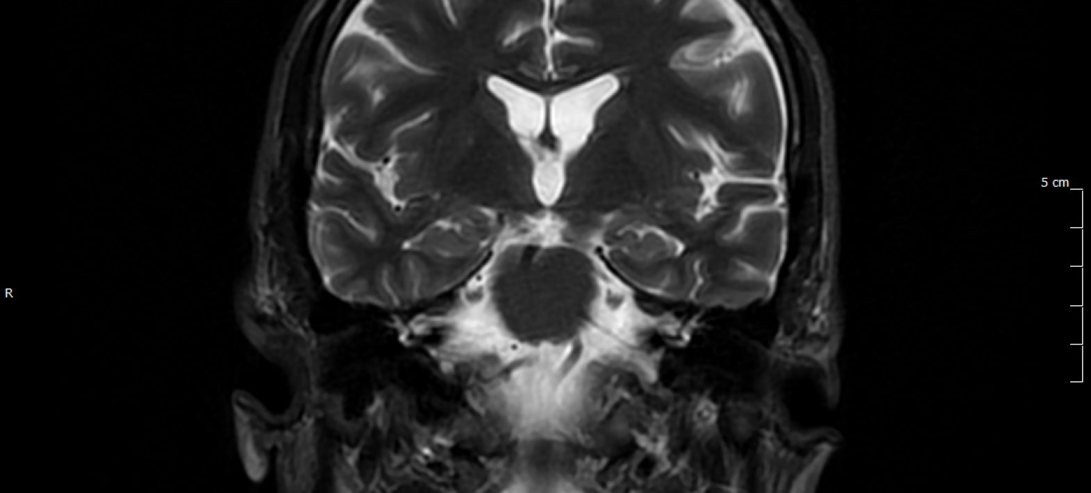 Le projet «Diagnose Alzheimer’s disease with isotopes » lauréat d’une ERC proof-of-concept !