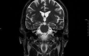 Le projet «Diagnose Alzheimer’s disease with isotopes » lauréat d’une ERC proof-of-concept !
