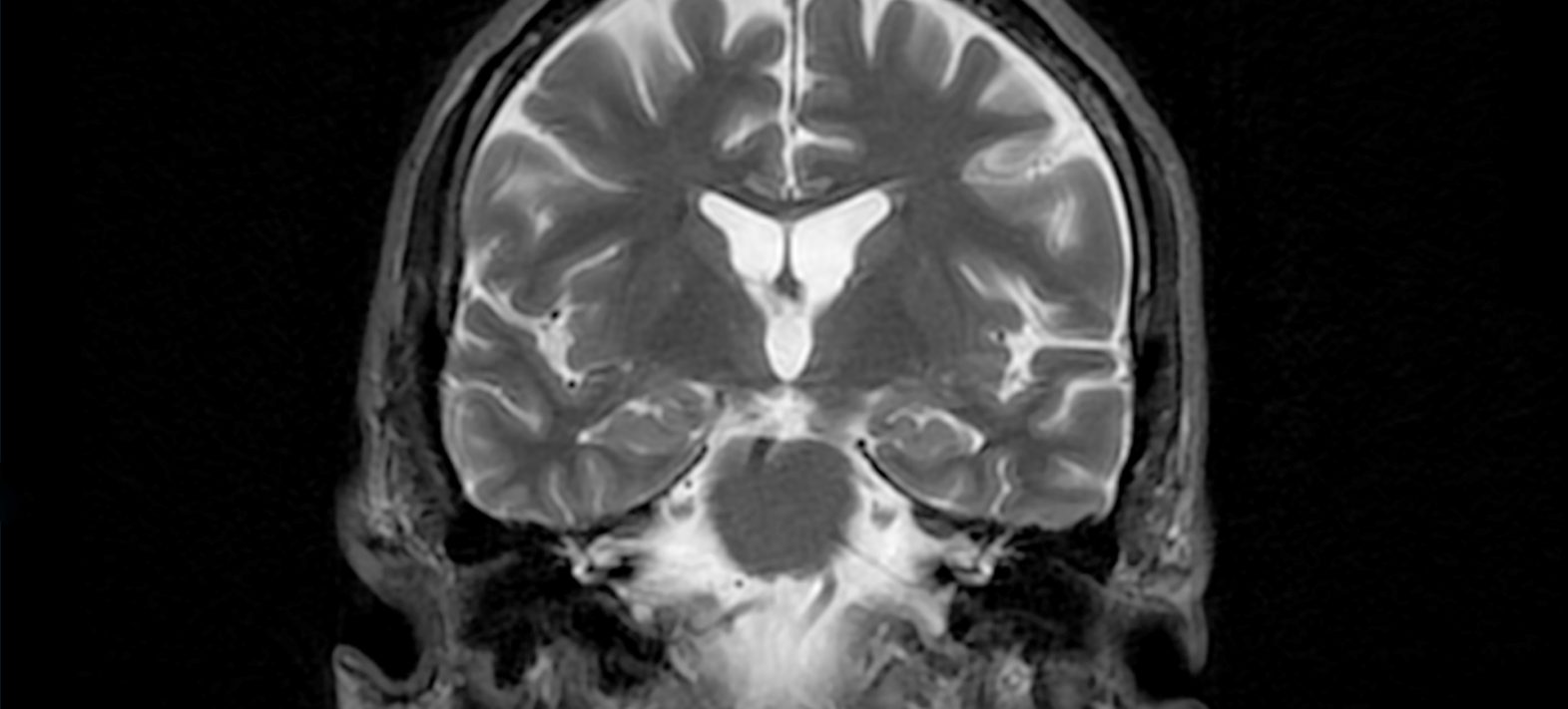 Maladie d’Alzheimer : la cosmochimie au service du cerveau