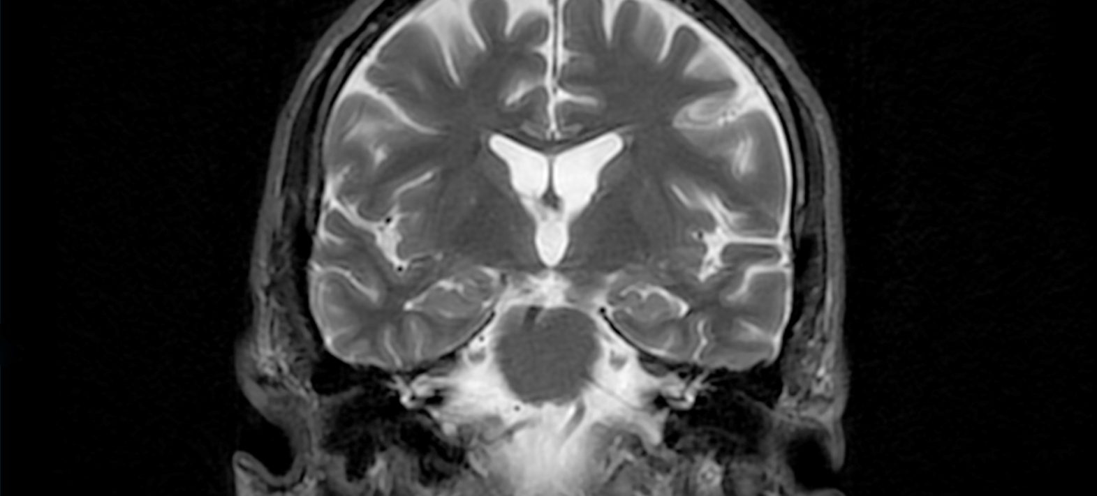 La cosmochimie au service du diagnostic de la maladie d&rsquo;Alzheimer : le cuivre révèle ses secrets isotopiques