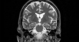 La cosmochimie au service du diagnostic de la maladie d'Alzheimer : le cuivre révèle ses secrets isotopiques