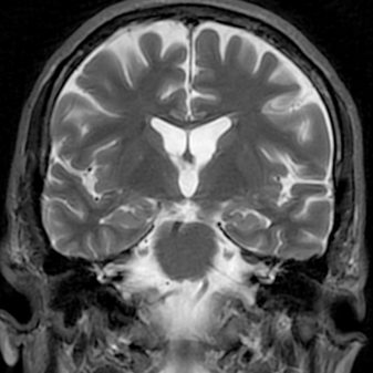 La cosmochimie au service du diagnostic de la maladie d'Alzheimer : le cuivre révèle ses secrets isotopiques