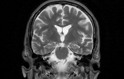 Cosmochemistry in the service of Alzheimer's disease diagnosis: copper reveals its isotopic secrets